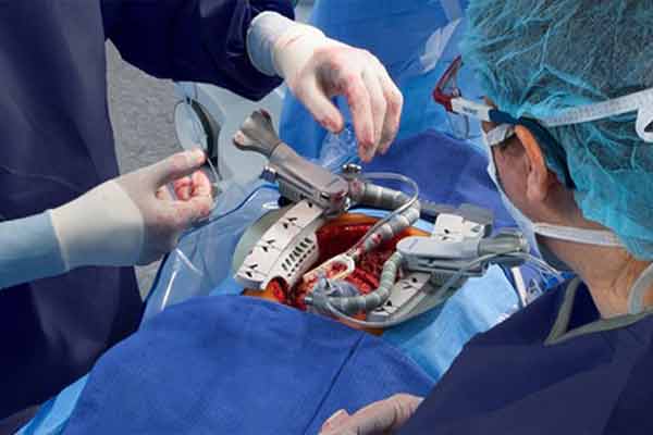 Beating Heart (Off-Pump)