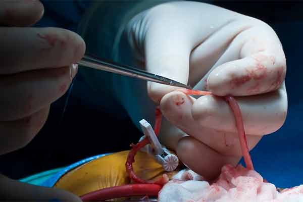 Coronary Bypass Surgery