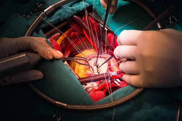 Heart Valve Replacement